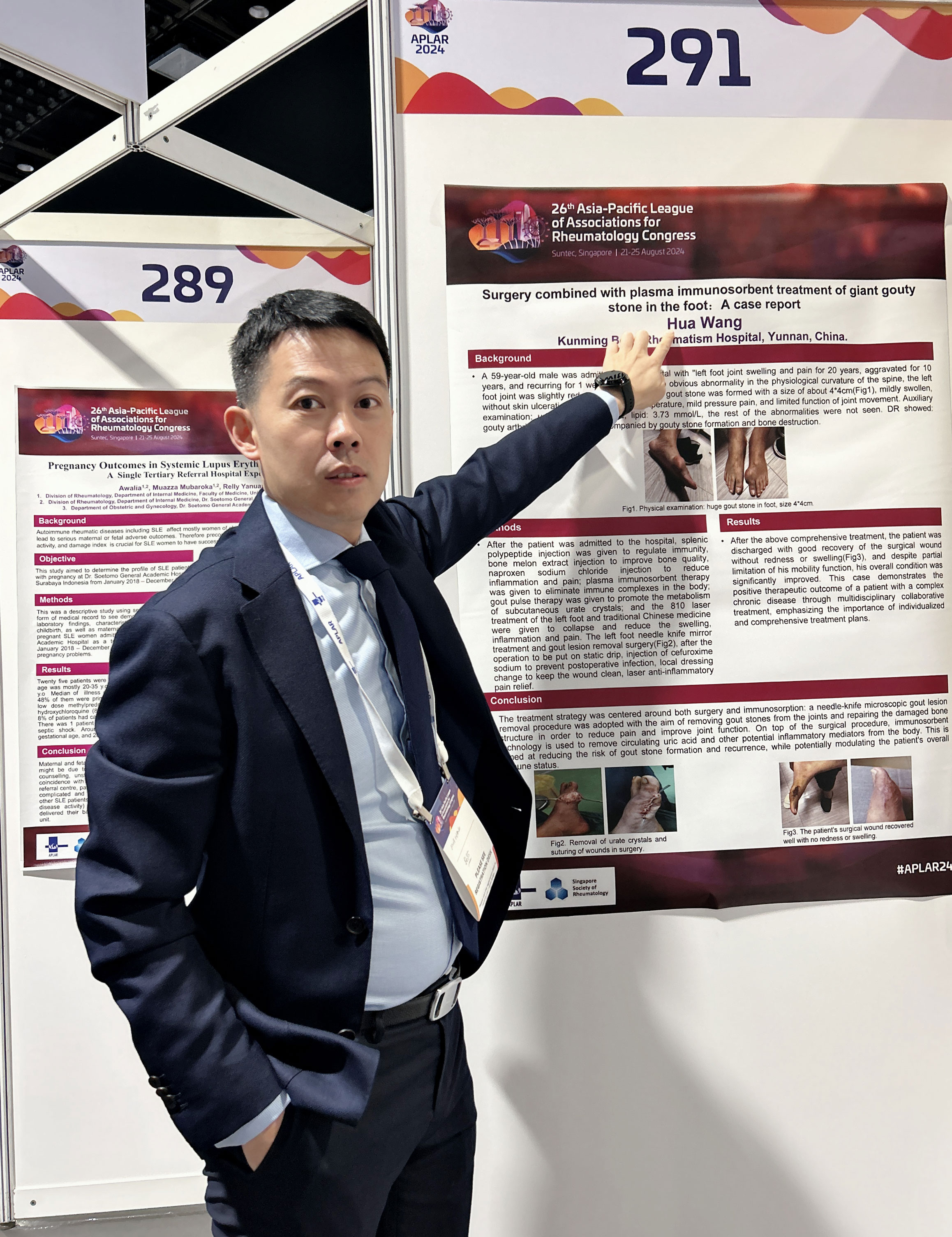 2024年8月21日，论文《病例报告：类风湿关节炎患者浅表二度烧伤后发生急性全身性脓疱疮》在第26届亚太风湿病学会（APLAR）年会会议中做壁报展示。.jpg